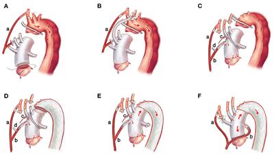 Total Arch Replacement With Frozen Elephant Trunk Using a NEW “Brain-Heart-First” Strategy for Acute DeBakey Type I Aortic Dissection Can Be Performed Under Mild Hypothermia (≥30°C) With Satisfactory Outcomes